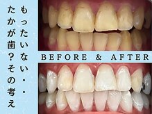 ホワイトニングショップ 八王子店/ホワイトニングビフォーアフター