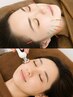 【美容鍼】たるみ・シワ・エイジングケア美容鍼BIO電流エステ40分コース