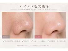 サマラボ 三軒茶屋(Sama Labo)の雰囲気（毛穴洗浄：皮脂・角栓・汚れを取り除きクリアな肌へ！）