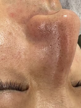 リコリス(Lycoris)/毛穴洗浄