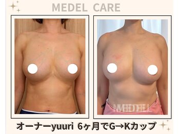 メデル 北千住店/バストアップ*育乳症例
