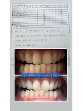 ホワイトニングショップ 久留米店(WHITENING SHOP)/ビフォーアフター