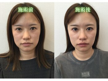 アプレシエ(Apprecier)/美容鍼の効果