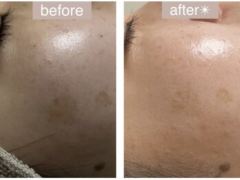 エバーグリーン(Evergreen)/ハーブピーリング4回の変化