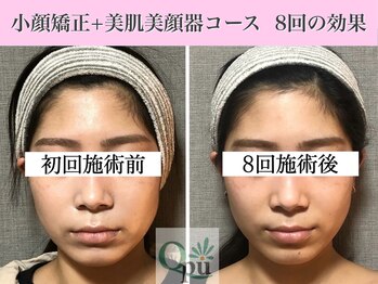 キュープ 表参道店(Qpu)/美顔器モニターコース8回の変化