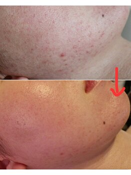 ベビースキン(baby skin)/肌改善