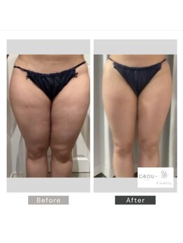 シーボウ(CBOU)/脂肪よう解　10ml(太もも)