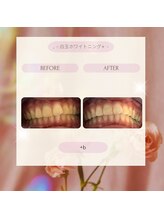 プラスビー 3号店(+b)/ホワイトニングビフォーアフター