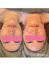 リラブルー(Lilas Bleu)/ハーブピーリング施術前後