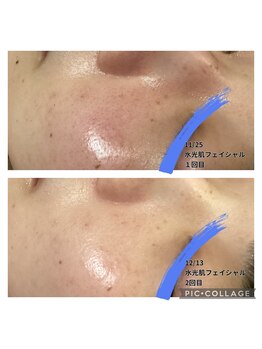 カレン/水光肌フェイシャル