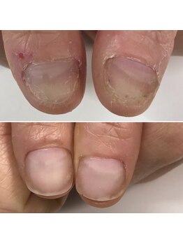 爪噛みでボロボロの爪が