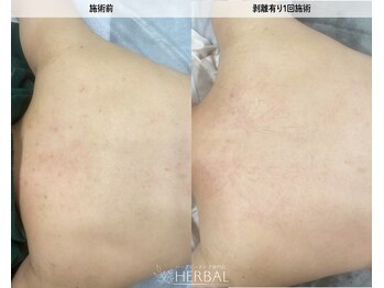 ハーバル 新宿店(HERBAL)/最強★韓国FCRハーブピーリング