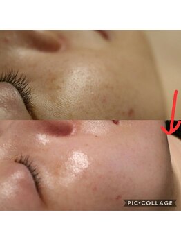 ベビースキン(baby skin)/肌改善