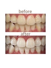 セルフホワイトニング専門店　 ホワイトニングショップ船橋2号店【ホワイトニング】/Before&After美白ホワイトニング