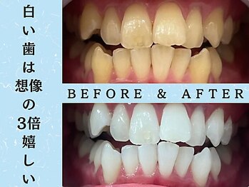 ホワイトニングショップ 八王子店/ホワイトニングビフォーアフター