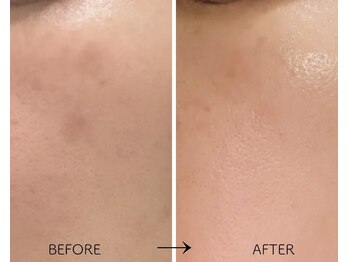 ココリラ(cocorira)の写真/夏までにシミ改善！プラズマケア1箇所無料◎2・3回目半額♪悩みを卒業し透明感肌へ！