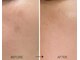 ココリラ(cocorira)の写真/夏までにシミ改善！プラズマケア1箇所無料◎2・3回目半額♪悩みを卒業し透明感肌へ！