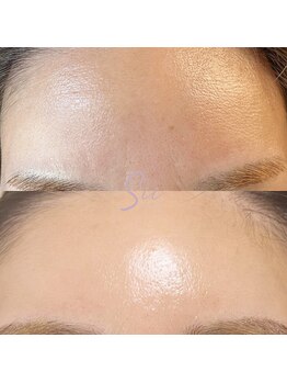 エマ(ema)/水光生美容液導入トリートメント