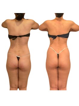 エミナル(EMINALu)/毛穴から究極のデトックス