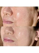 カルナ(CARNA)/トラブルのラスボス【毛穴改善】