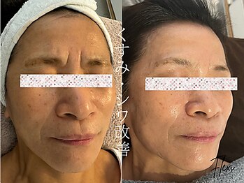 フレキシ 表参道(Flexi)/小顔＋ハーブピーリング