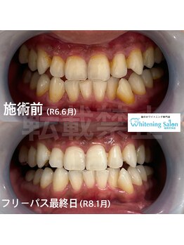 ホワイトニングサロン 福岡天神店/ホワイトニング