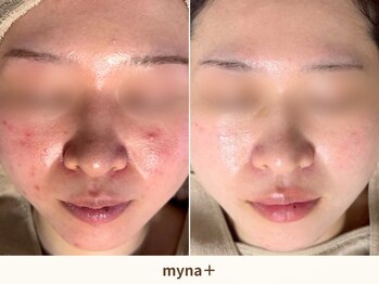 マイナプラ 表参道(myna+)/CHRISTINA/ハーブピーリング