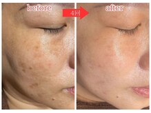 パールホワイトニングサロン 大和店の雰囲気（シミポイントケアで5日後に！劇的変化シミ改善大和シミケア/毛穴）