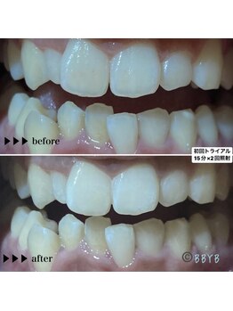 ビーバイビー(BBYB)/ホワイトスポットについて