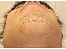 フィズ 浦和店(FIS)/☆脱毛途中経過［浦和/ひげ］