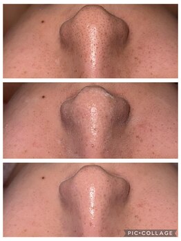 ビューティールーム リヴィア(BEAUTY ROOM RIVIA)/ハイドロ毛穴洗浄¥5500