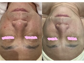 じゅえる/男性にも人気!シミケア