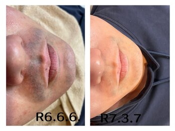 フィズ 五日市彩が丘店(FIS)/☆before/after☆髭脱毛