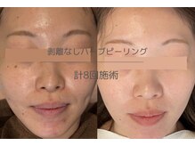 ライフ美容整体院 恵比寿(Life美容整体院)/剥離なしハーブピーリング