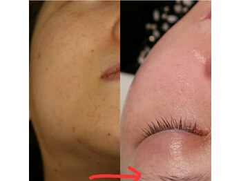 ベビースキン(baby skin)/肌改善