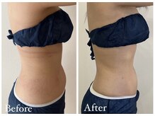 アンドモア(&more)/痩身症例