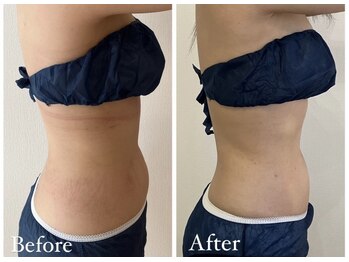 アンドモア(&more)/痩身症例