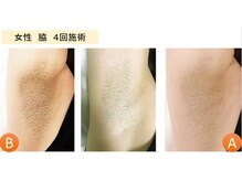 ラグゼ(LUXE)/部分脱毛人気NO.1　わき脱毛