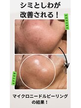 ラ ヴォーテ(La beaute)/マイクロニードルピーリング