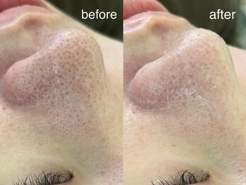 テオリア(TEORIA)/肌質改善☆彡毛穴ケア