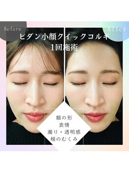 スイートボイス(sweet voice)/クイックコルギビフォーアフター