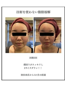モアナ(Moana)/脂肪燃焼剤導入×小顔コルギ