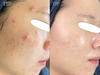 ダリア(Dahlia)/ハーブピーリング