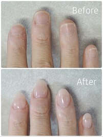 【即日見た目改善】深爪矯正