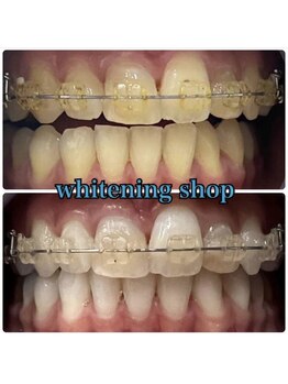 ホワイトニングショップ 大宮店/矯正中の方もご利用いただけます