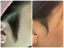 アロラヴィ(AroRavi)/脱毛デザインできます