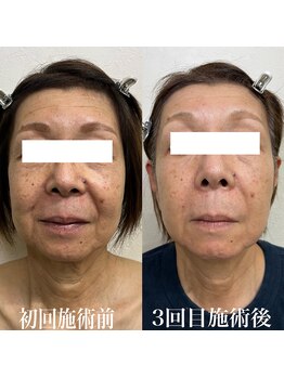 コリー(Kolly)/まるで別人級！