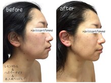 ラヴィソンファム(Ravissant femme)/40代1回小顔フェイシャル