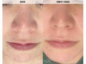 ハーバル 新宿店(HERBAL)/最強★韓国FCRハーブピーリング