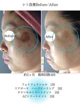 ルノン(LUNON)/シミケアBefore/After